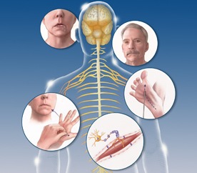 Amyotrophic lateral sclerosis (ALS)